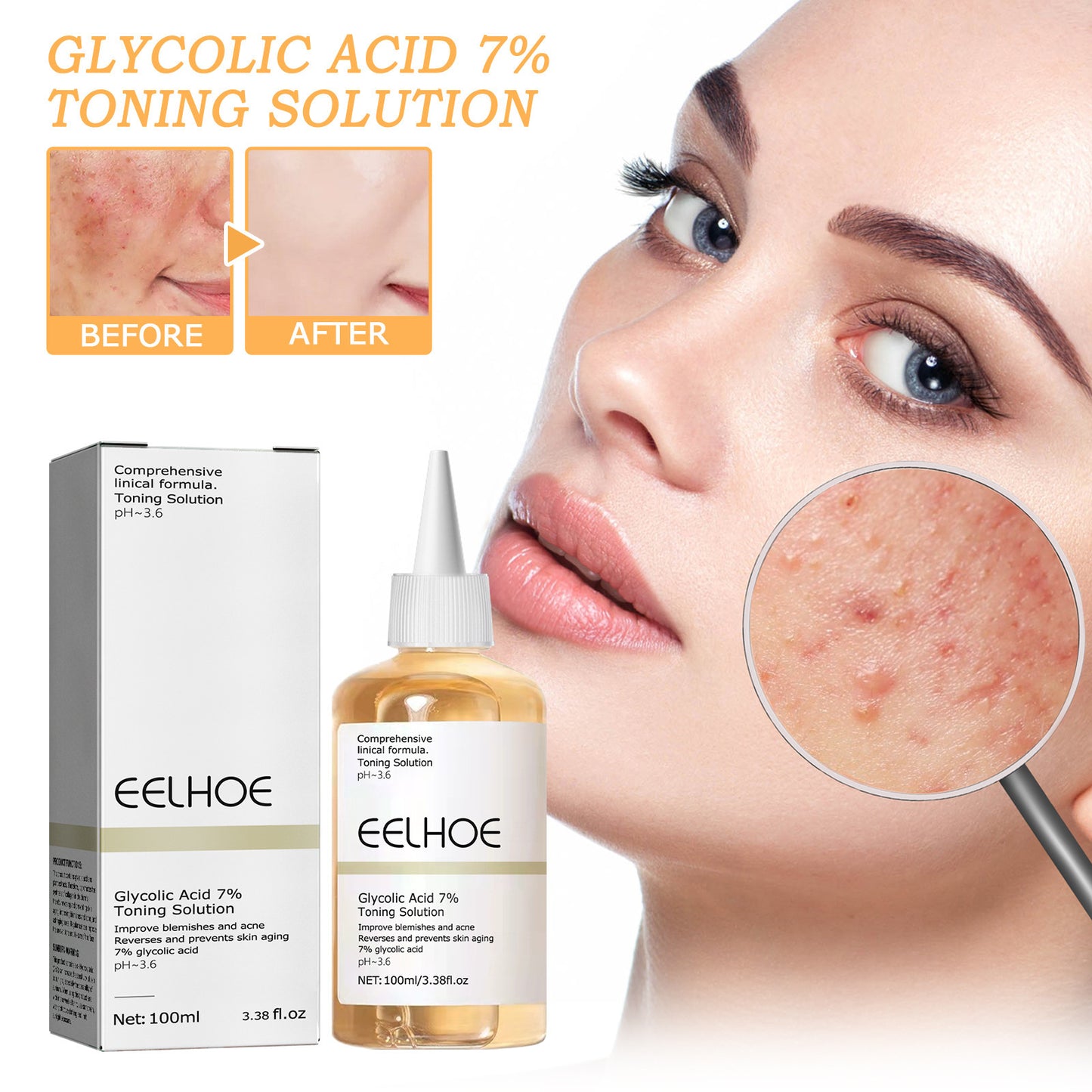 Glycolic Acid 7 Lotion Acne Removing Closed Mouth